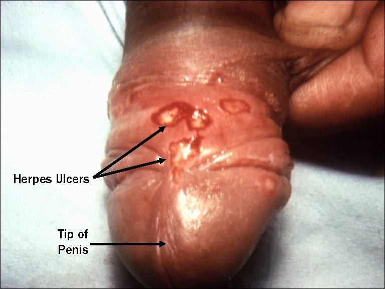 Herpes Ulcers Tip of Penis 