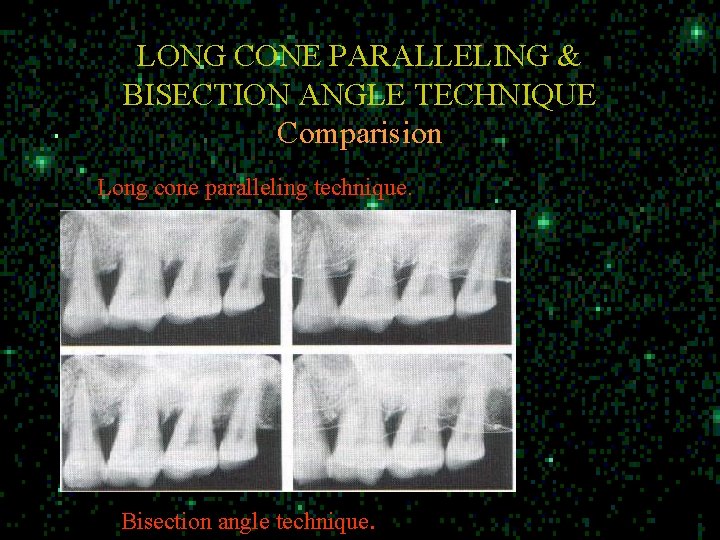 LONG CONE PARALLELING & BISECTION ANGLE TECHNIQUE Comparision Long cone paralleling technique. Bisection angle