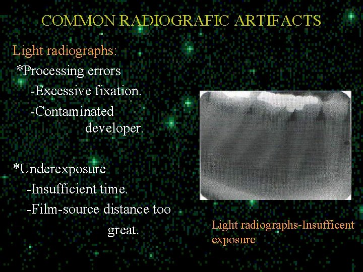 COMMON RADIOGRAFIC ARTIFACTS Light radiographs: *Processing errors -Excessive fixation. -Contaminated developer. *Underexposure -Insufficient time.