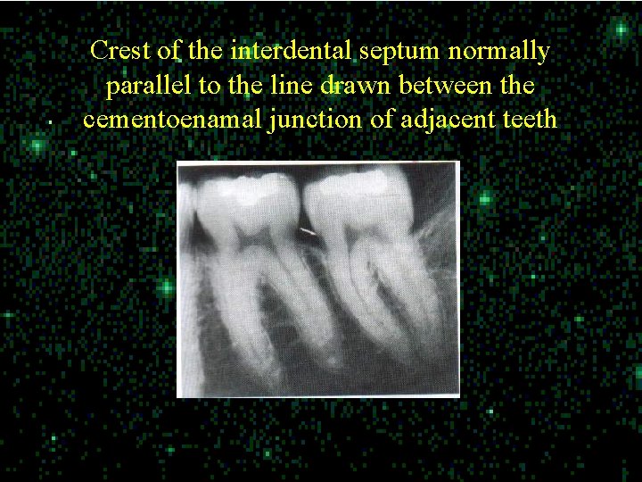 Crest of the interdental septum normally parallel to the line drawn between the cementoenamal