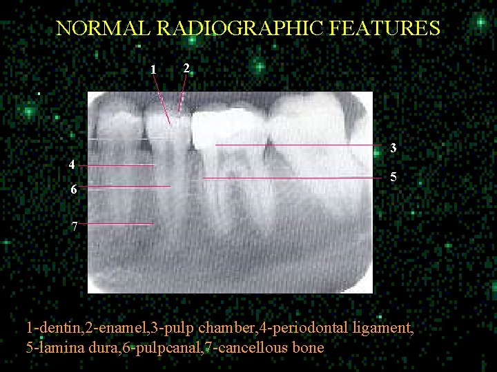 NORMAL RADIOGRAPHIC FEATURES 11 2 3 4 6 5 7 1 -dentin, 2 -enamel,