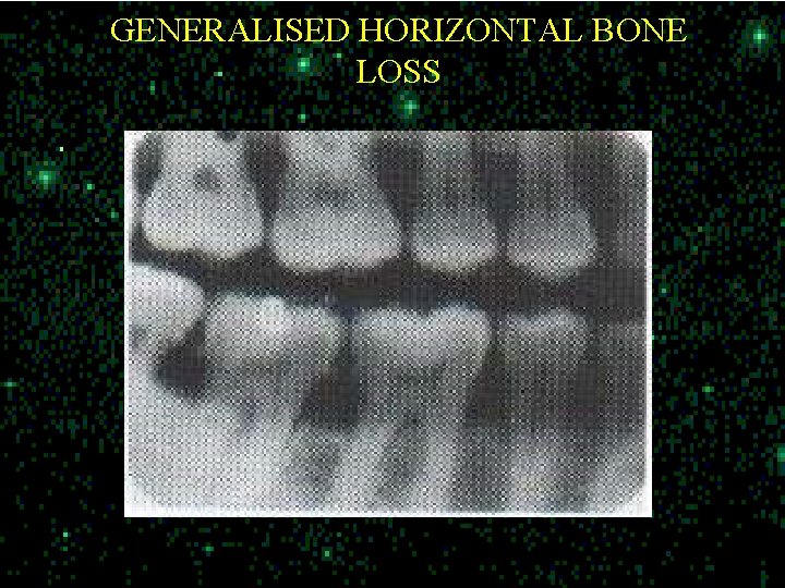 GENERALISED HORIZONTAL BONE LOSS 