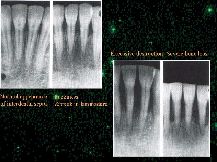 Normal appearance of interdental septa Excessive destruction Severe bone loss Fuzziness &break in laminadura