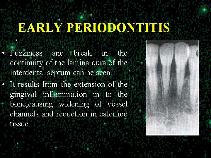 EARLY PERIODONTITIS • Fuzziness and break in the continuity of the lamina dura of