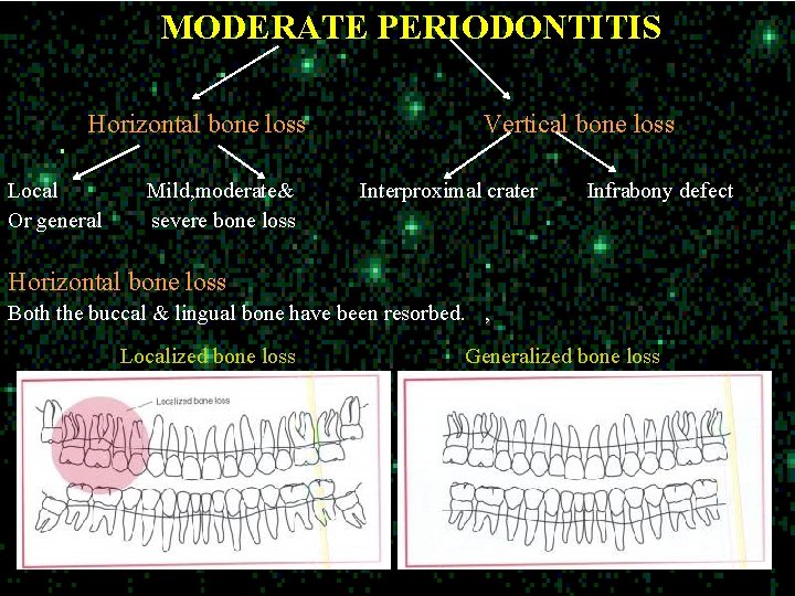 MODERATE PERIODONTITIS Horizontal bone loss Local Or general Mild, moderate& severe bone loss Vertical