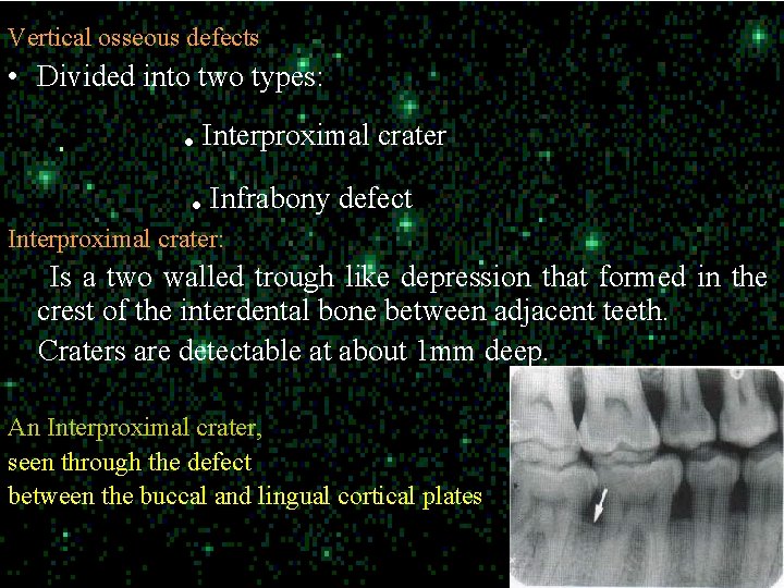 Vertical osseous defects • Divided into two types: . Interproximal crater. Infrabony defect Interproximal