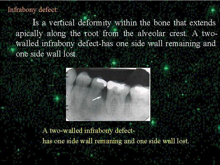 Infrabony defect: Is a vertical deformity within the bone that extends apically along the