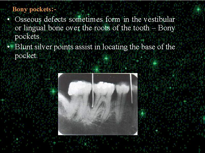 Bony pockets: - • Osseous defects sometimes form in the vestibular or lingual bone