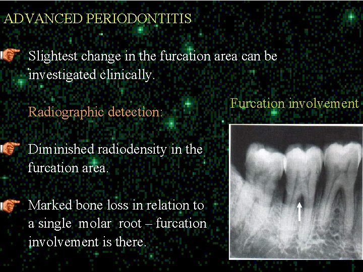 ADVANCED PERIODONTITIS Slightest change in the furcation area can be investigated clinically. Radiographic detection: