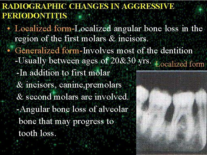 RADIOGRAPHIC CHANGES IN AGGRESSIVE PERIODONTITIS • Localized form-Localized angular bone loss in the region