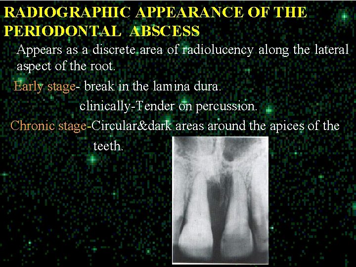 RADIOGRAPHIC APPEARANCE OF THE PERIODONTAL ABSCESS Appears as a discrete area of radiolucency along