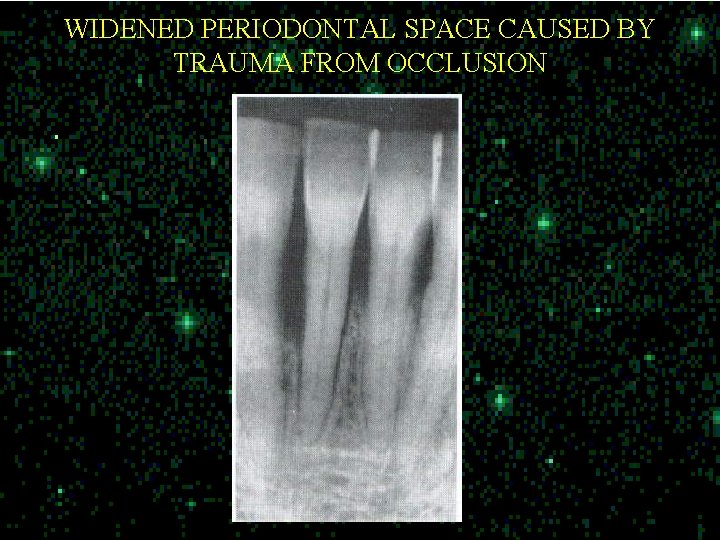 WIDENED PERIODONTAL SPACE CAUSED BY TRAUMA FROM OCCLUSION 