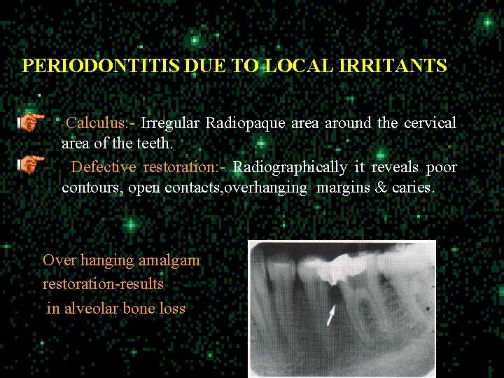 PERIODONTITIS DUE TO LOCAL IRRITANTS Calculus: - Irregular Radiopaque area around the cervical area