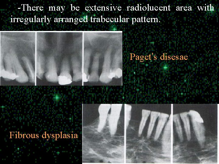 -There may be extensive radiolucent area with irregularly arranged trabecular pattern. Paget’s disesae Fibrous