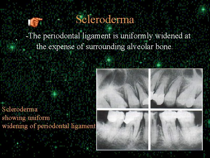 Scleroderma -The periodontal ligament is uniformly widened at the expense of surrounding alveolar bone.