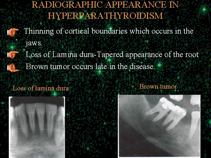 RADIOGRAPHIC APPEARANCE IN HYPERPARATHYROIDISM Thinning of cortical boundaries which occurs in the jaws. Loss