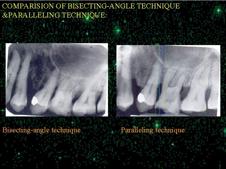 COMPARISION OF BISECTING-ANGLE TECHNIQUE &PARALLELING TECHNIQUE: Bisecting-angle technique Paralleling technique 