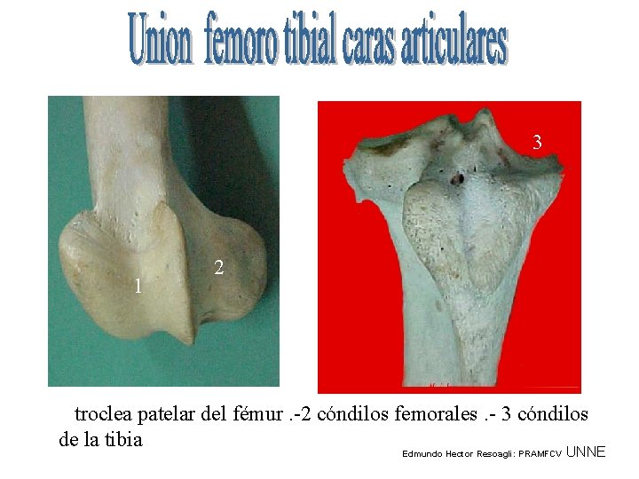 3 1 2 1 troclea patelar del fémur. -2 cóndilos femorales. - 3 cóndilos