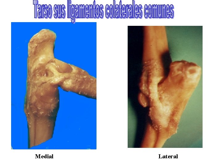 Medial Lateral 