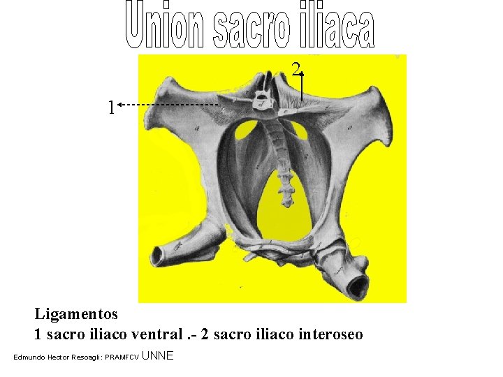 2 1 Ligamentos 1 sacro iliaco ventral. - 2 sacro iliaco interoseo Edmundo Hector