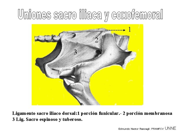 1 2 3 Ligamento sacro iliaco dorsal: 1 porción funicular. - 2 porción membranosa