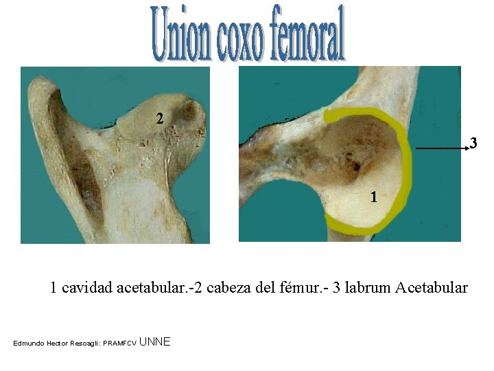 2 3 1 1 cavidad acetabular. -2 cabeza del fémur. - 3 labrum Acetabular