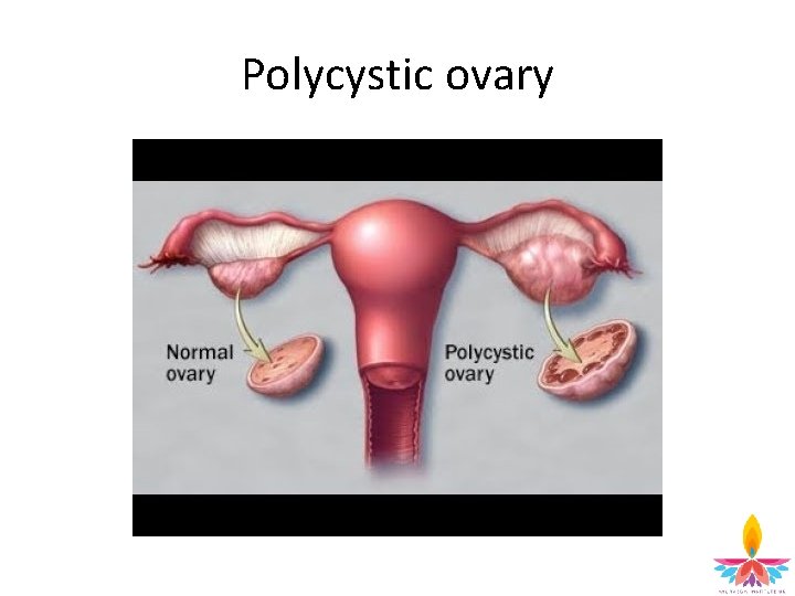 Polycystic ovary 