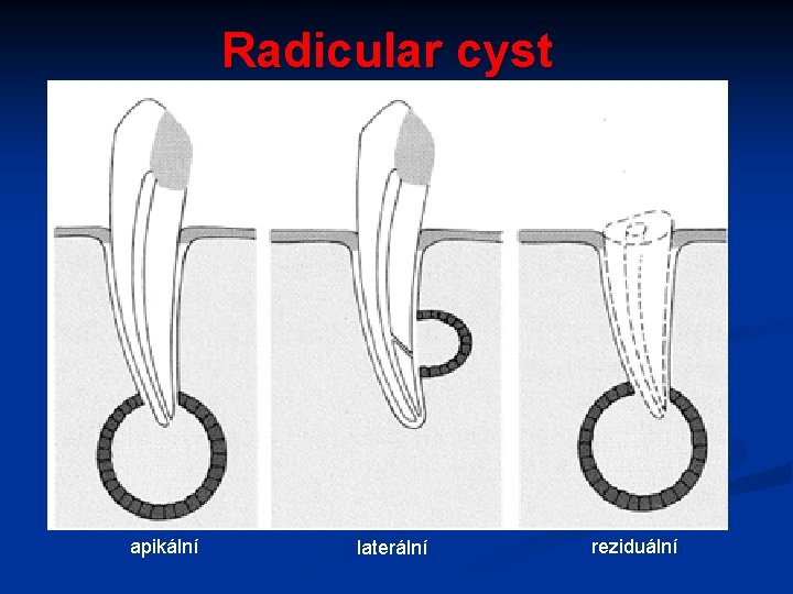 Radicular cyst apikální laterální reziduální 