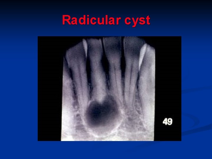 Radicular cyst 