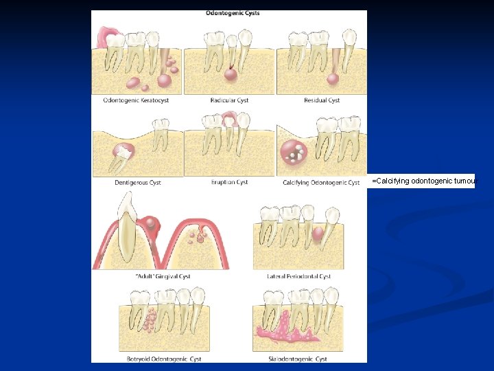 =Calcifying odontogenic tumour 