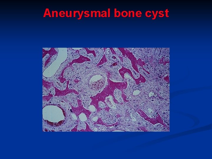 Aneurysmal bone cyst 