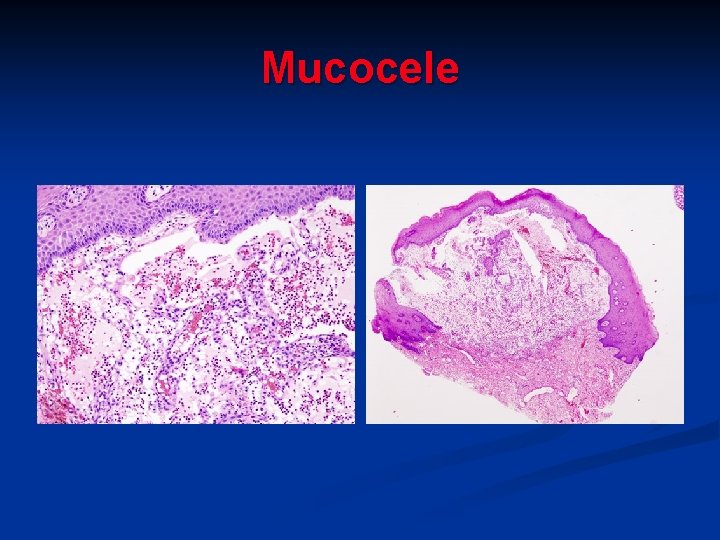 Mucocele 