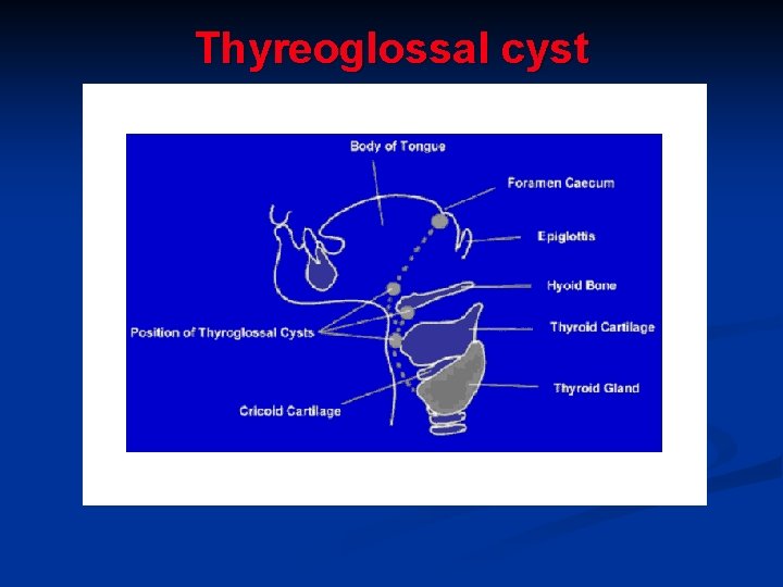 Thyreoglossal cyst 