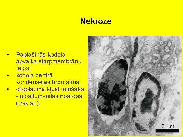 Nekroze • • • Paplašinās kodola apvalka starpmembrānu telpa; kodola centrā kondensējas hromatīns; citoplazma