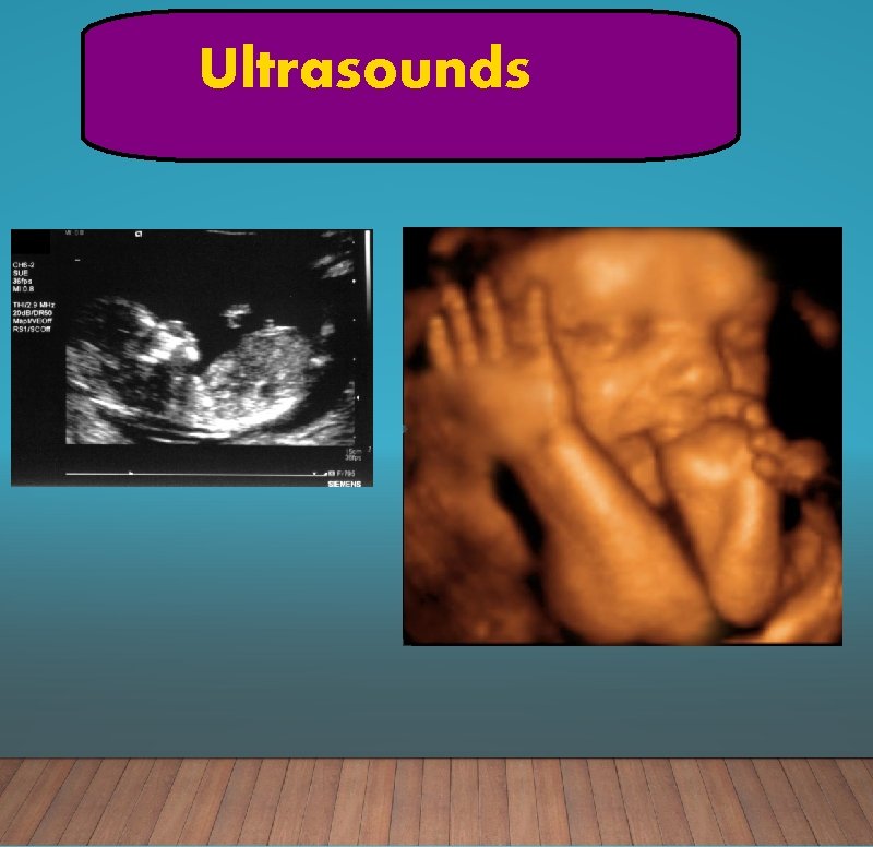 Ultrasounds 