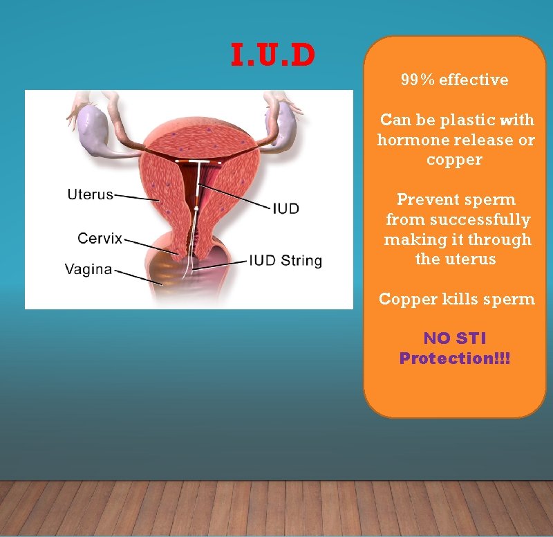 I. U. D 99% effective Can be plastic with hormone release or copper Prevent