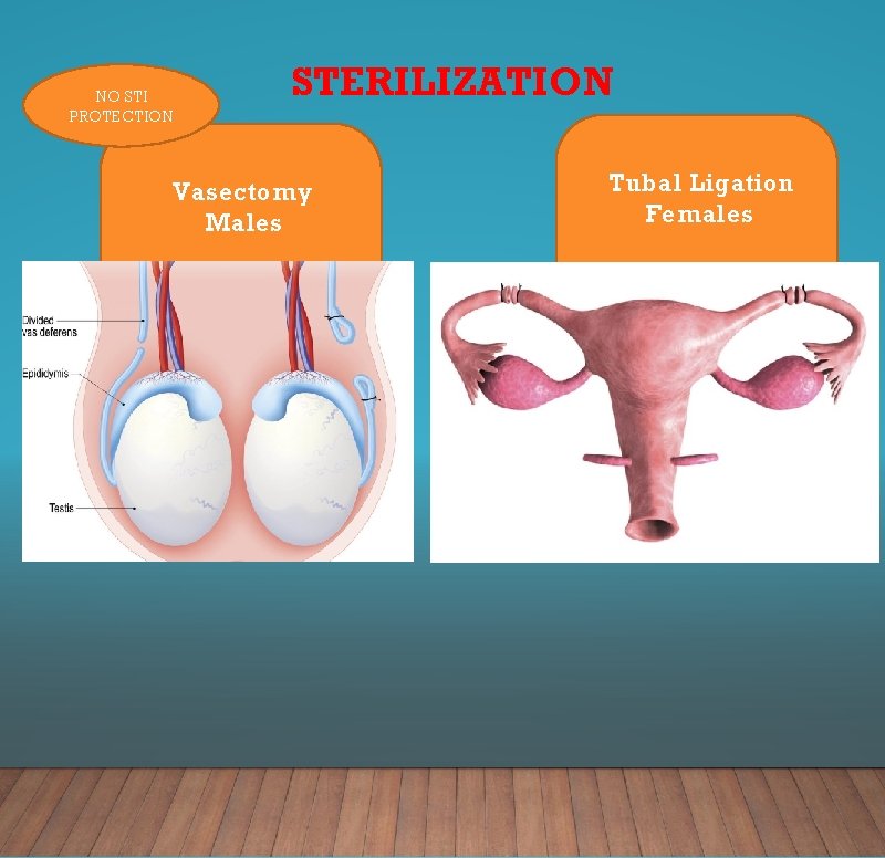 NO STI PROTECTION STERILIZATION Vasectomy Males Tubal Ligation Females 