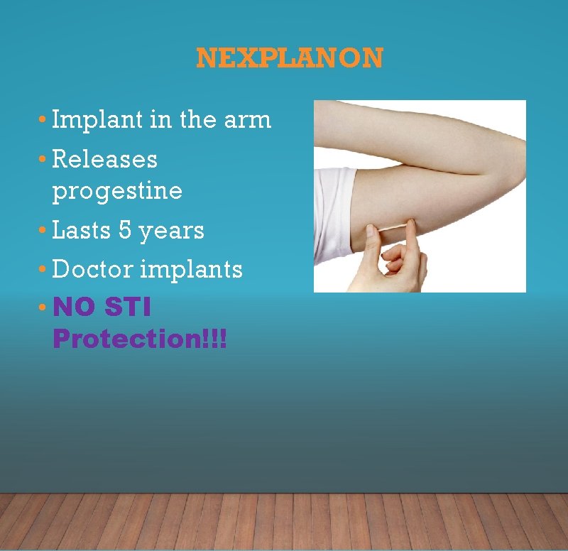 NEXPLANON • Implant in the arm • Releases progestine • Lasts 5 years •