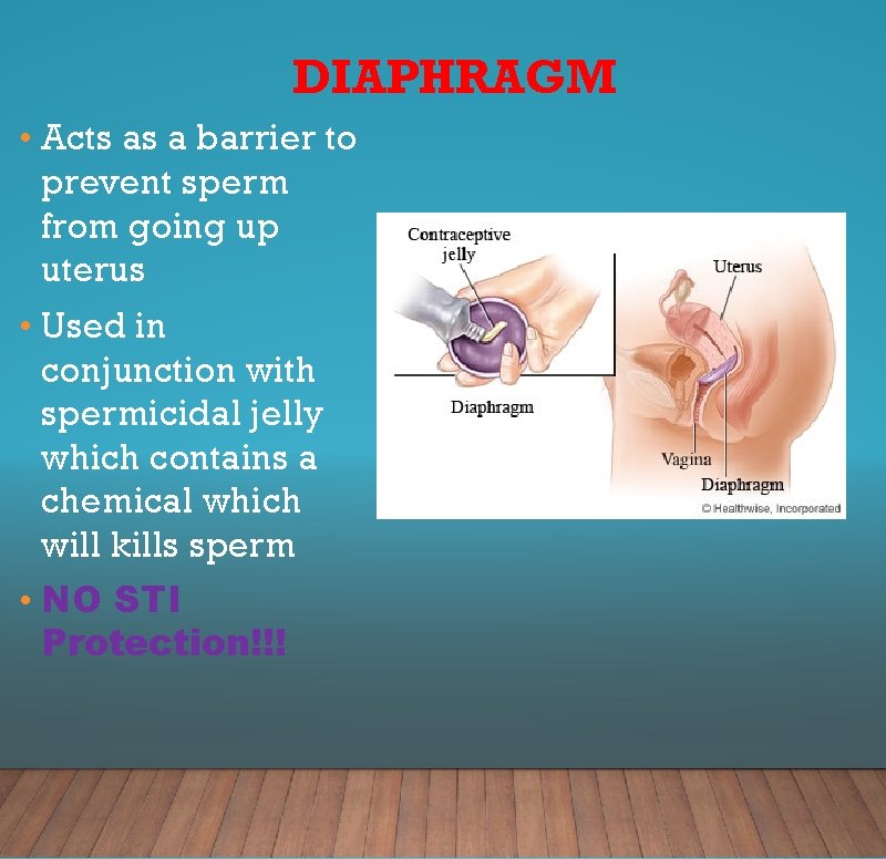 DIAPHRAGM • Acts as a barrier to prevent sperm from going up uterus •