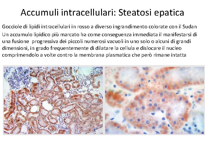 Accumuli intracellulari: Steatosi epatica Gocciole di lipidi intracellulari in rosso a diverso ingrandimento colorate