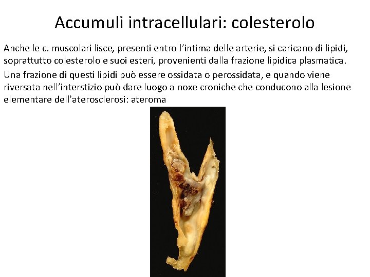 Accumuli intracellulari: colesterolo Anche le c. muscolari lisce, presenti entro l’intima delle arterie, si