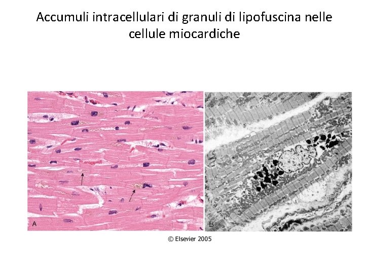 Accumuli intracellulari di granuli di lipofuscina nelle cellule miocardiche 