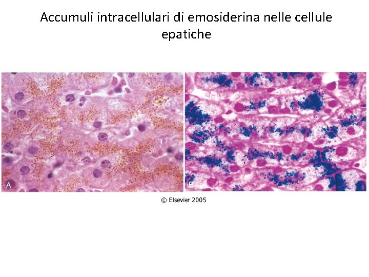 Accumuli intracellulari di emosiderina nelle cellule epatiche 