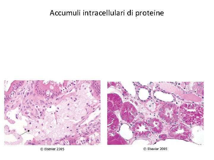 Accumuli intracellulari di proteine 
