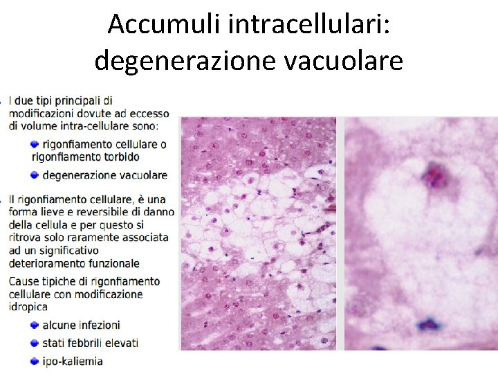 Accumuli intracellulari: degenerazione vacuolare 