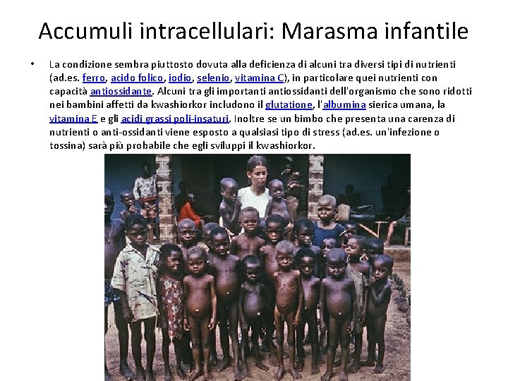 Accumuli intracellulari: Marasma infantile • La condizione sembra piuttosto dovuta alla deficienza di alcuni