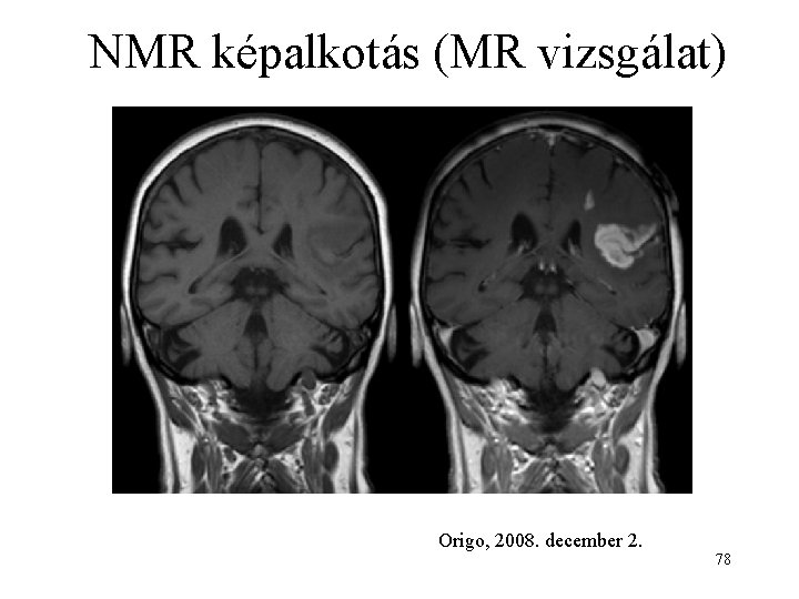 NMR képalkotás (MR vizsgálat) Origo, 2008. december 2. 78 