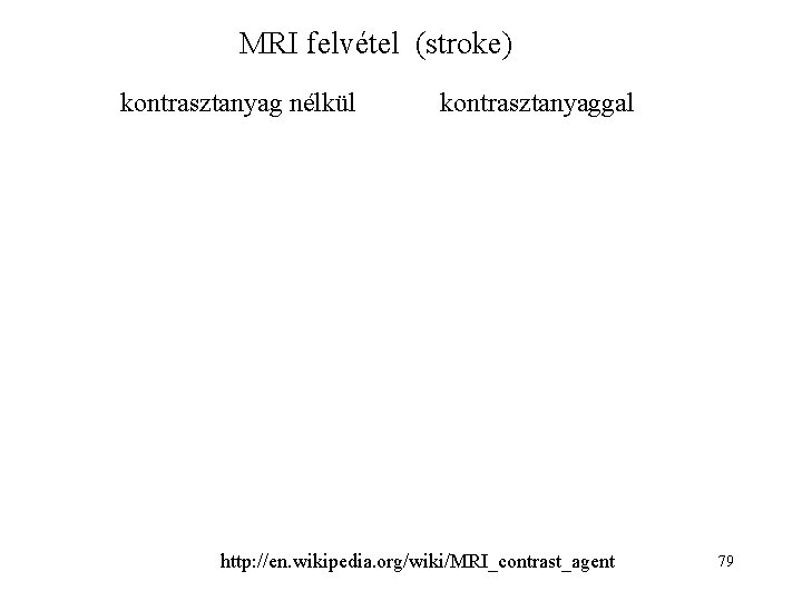 MRI felvétel (stroke) kontrasztanyag nélkül kontrasztanyaggal http: //en. wikipedia. org/wiki/MRI_contrast_agent 79 