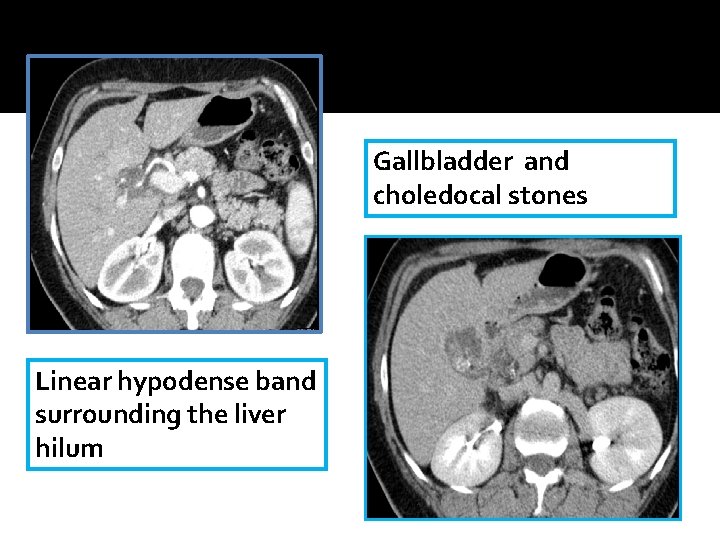 Gallbladder and choledocal stones Linear hypodense band surrounding the liver hilum Gallbladder and choledocal stones Linear hypodense band surrounding the liver hilum
