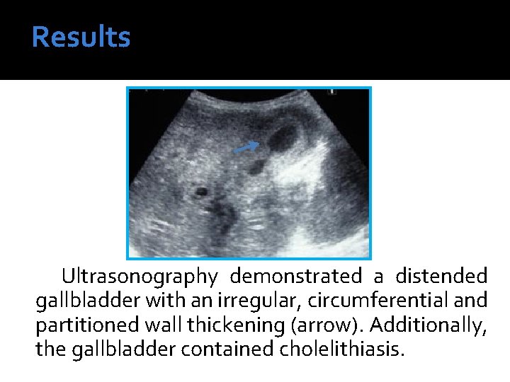 Results Ultrasonography demonstrated a distended gallbladder with an irregular, circumferential and partitioned wall thickening Results Ultrasonography demonstrated a distended gallbladder with an irregular, circumferential and partitioned wall thickening
